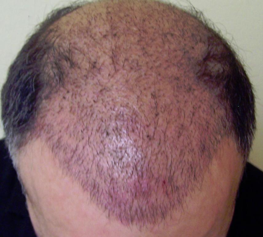 regrow hair after chemo